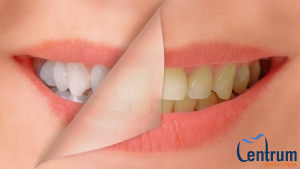 Showing before and after teeth whitening.