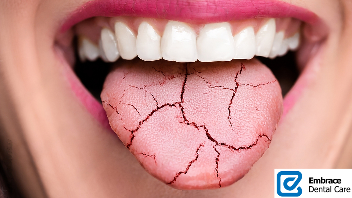 8 Facts About Dry Mouth (Dehydration Is Only One Potential Cause)