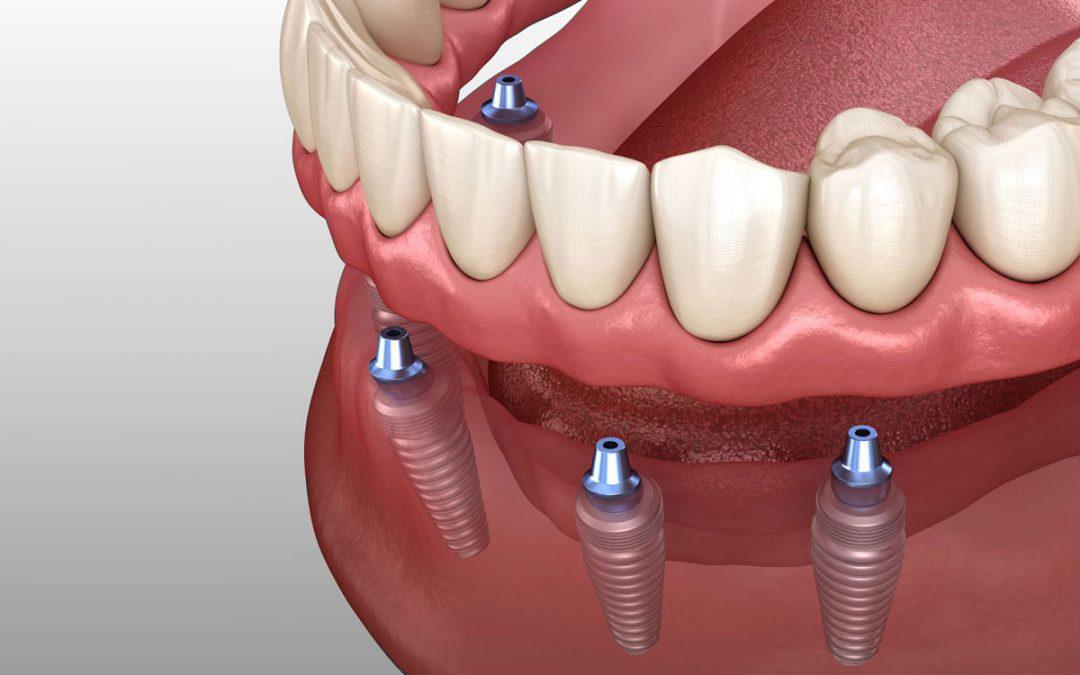 Implant Dentures Pros and Cons Denture Care Blog & News Hayven Dentures St. Catherines