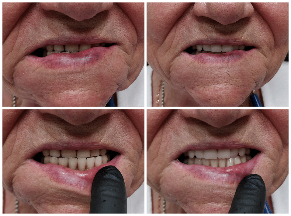 Dental Flippers Hayven Dentures St. Catherines