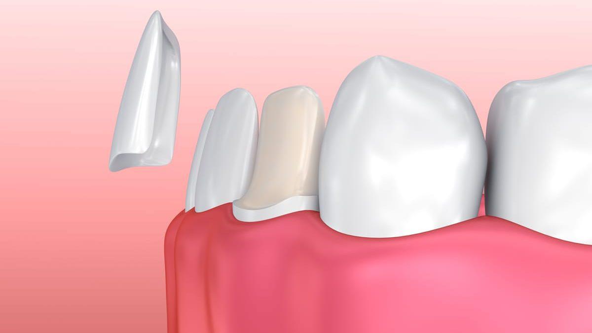Dental Veneers in Kitchener de Man & Höediono Dentistry Kitchener