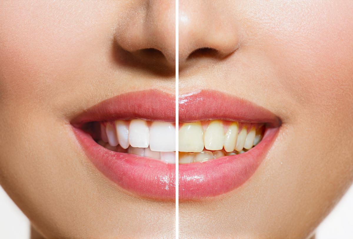 Teeth Whitening Dentist in Brandon MB